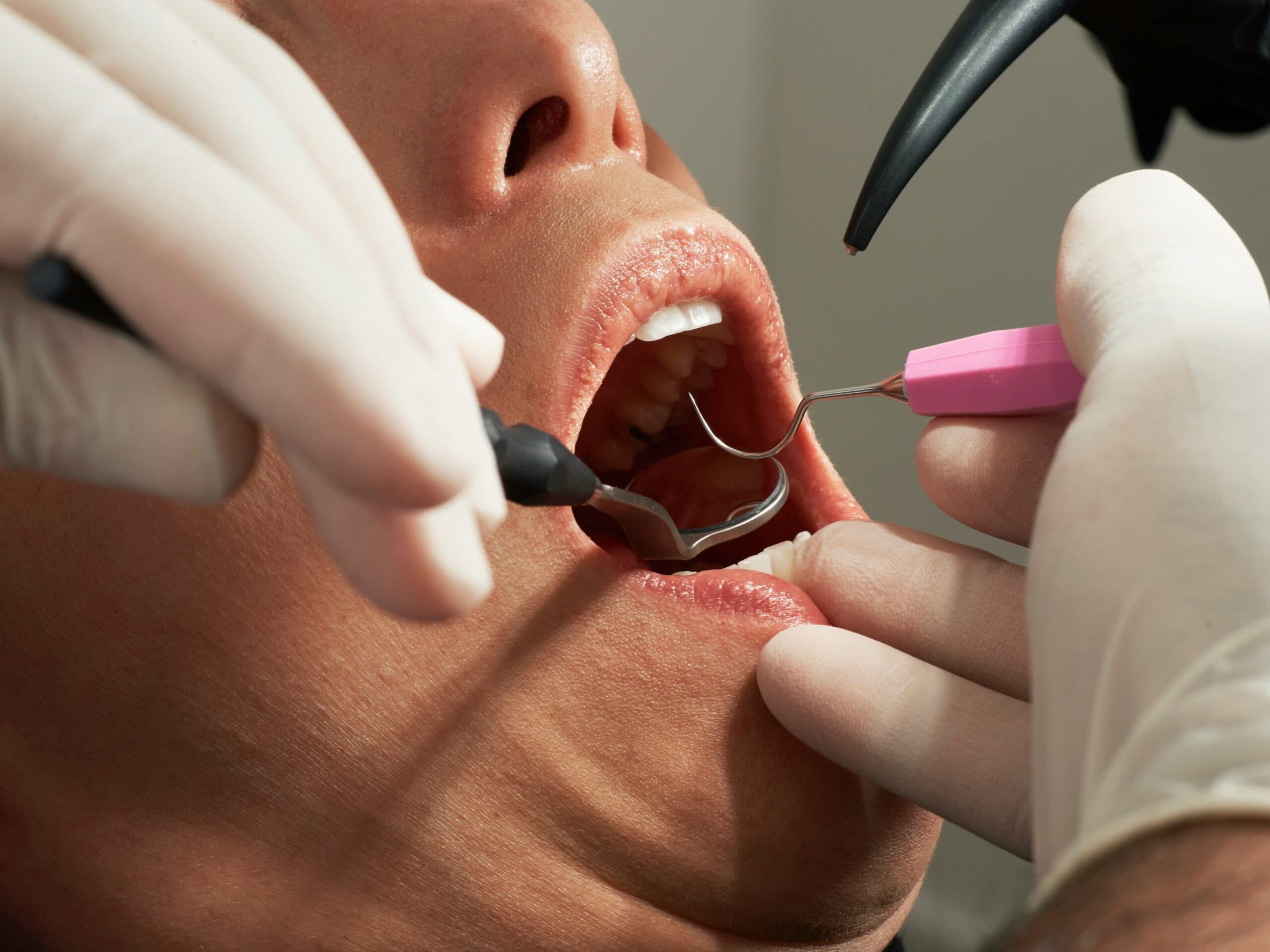 Should You Replace Your Dental Filling? A Decision Guide for Aging Restorations